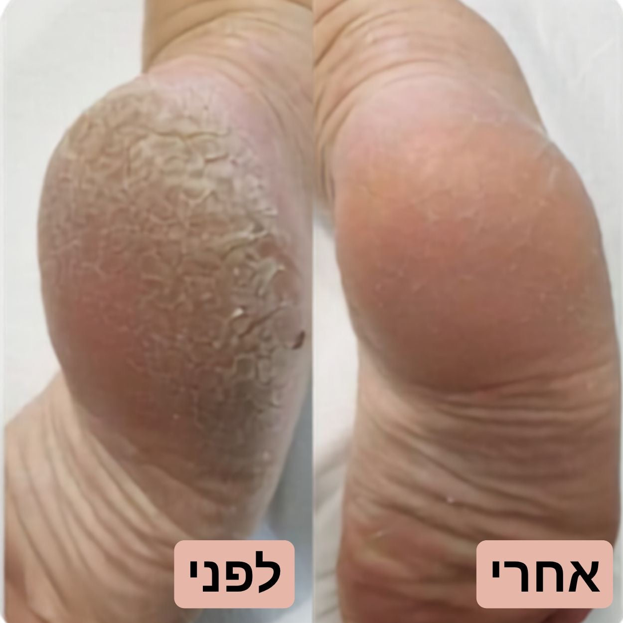 מכשיר פדיקור חשמלי להסרת עור קשה