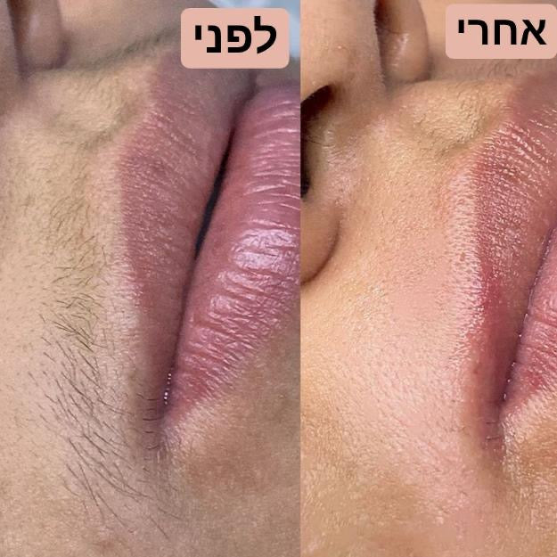 מכשיר להסרת השיער בפנים