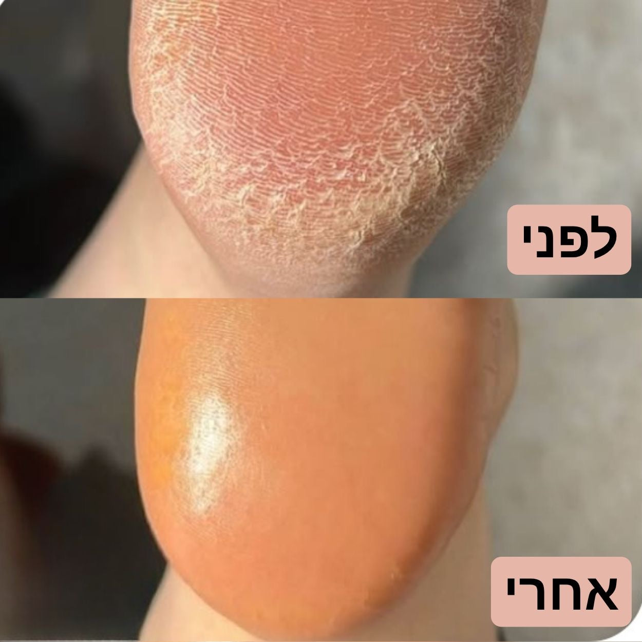מכשיר פדיקור חשמלי להסרת עור קשה