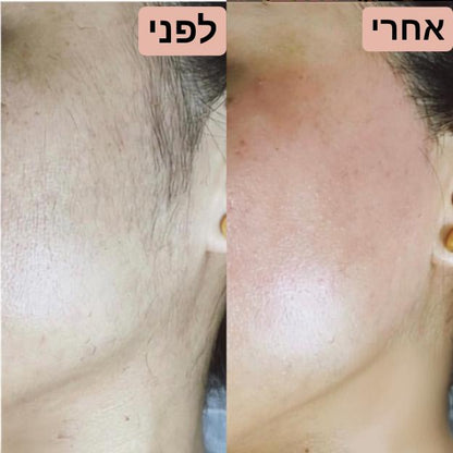 מכשיר להסרת השיער בפנים